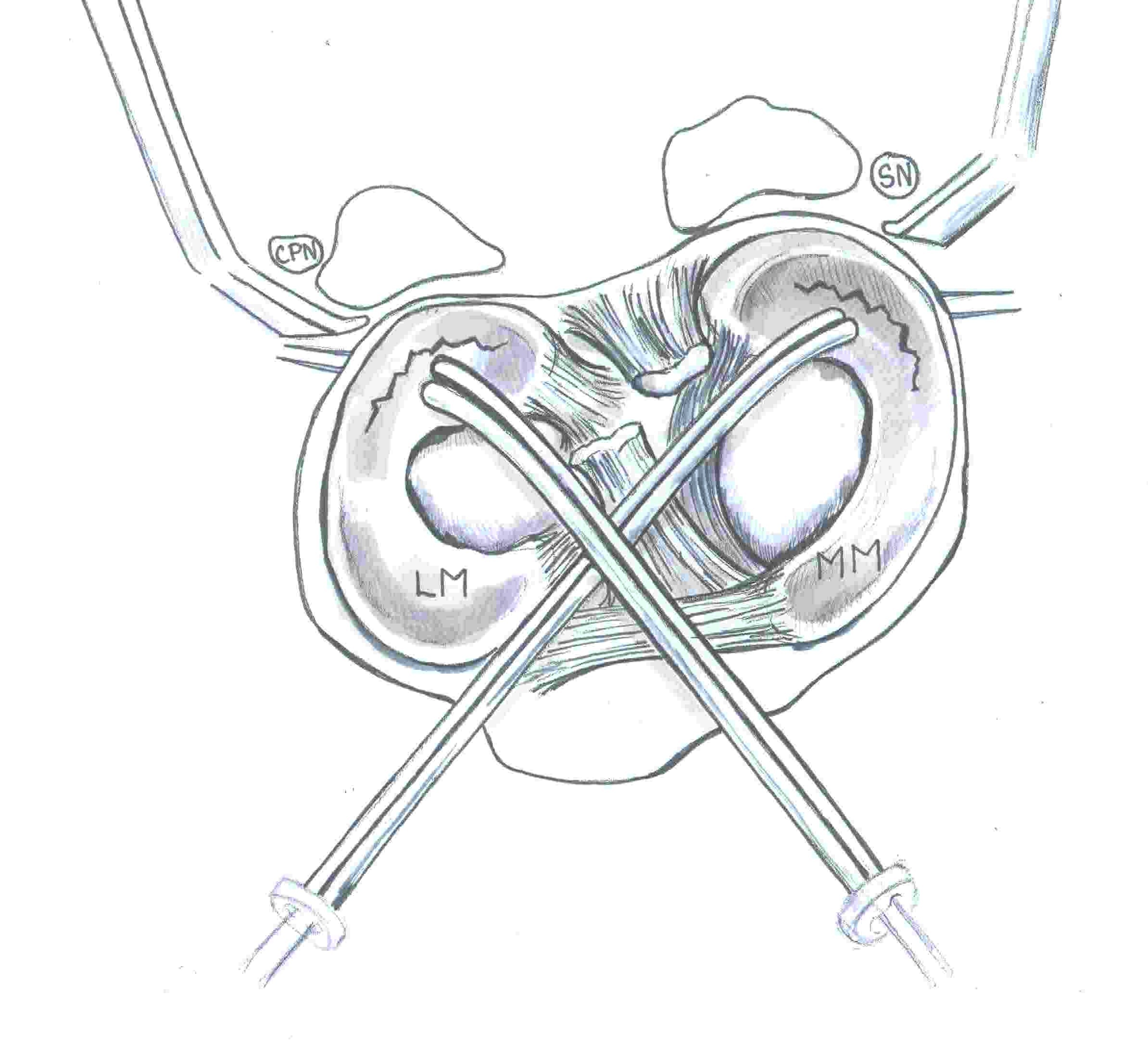 Inside out Mensical Repair Structures at Risk